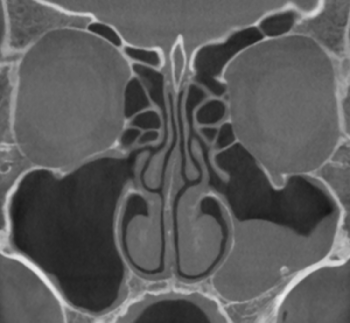 膿がたまった副鼻腔内部のCT画像